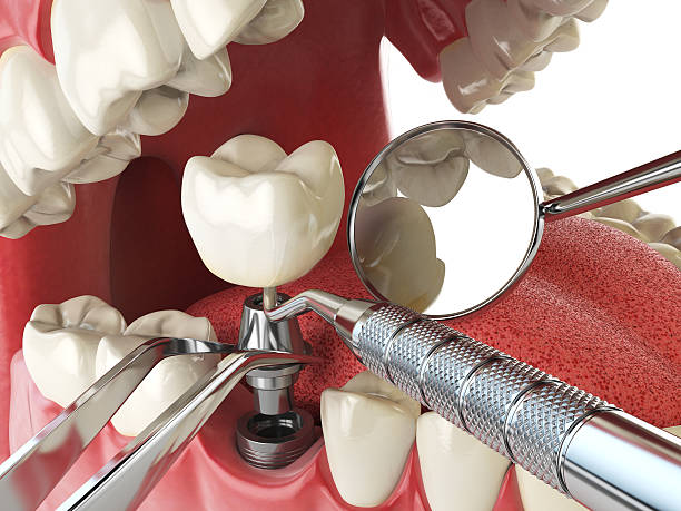 Best Chipped Tooth Repair Near Me  in Audubon Park, KY